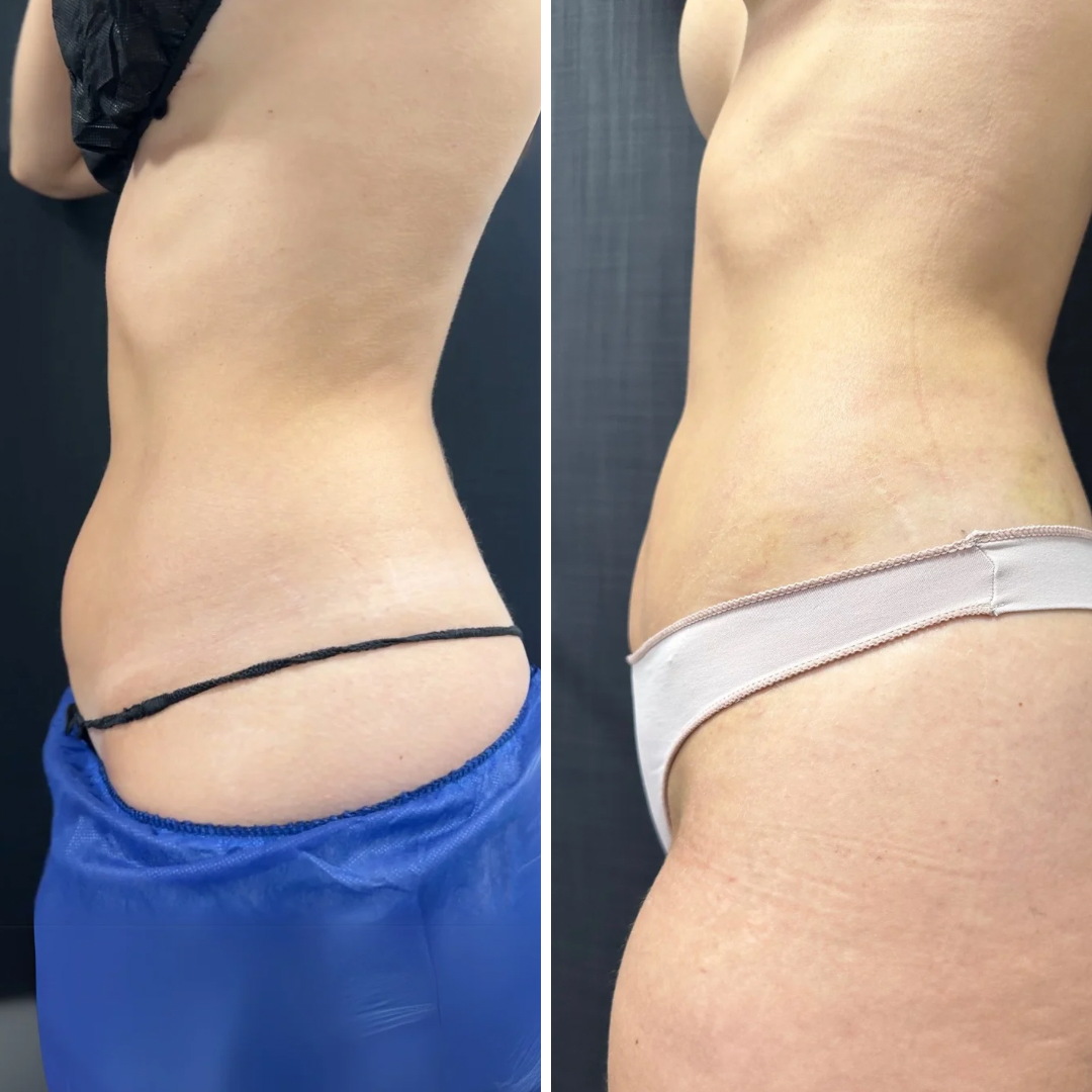 Resultado Antes e Depois